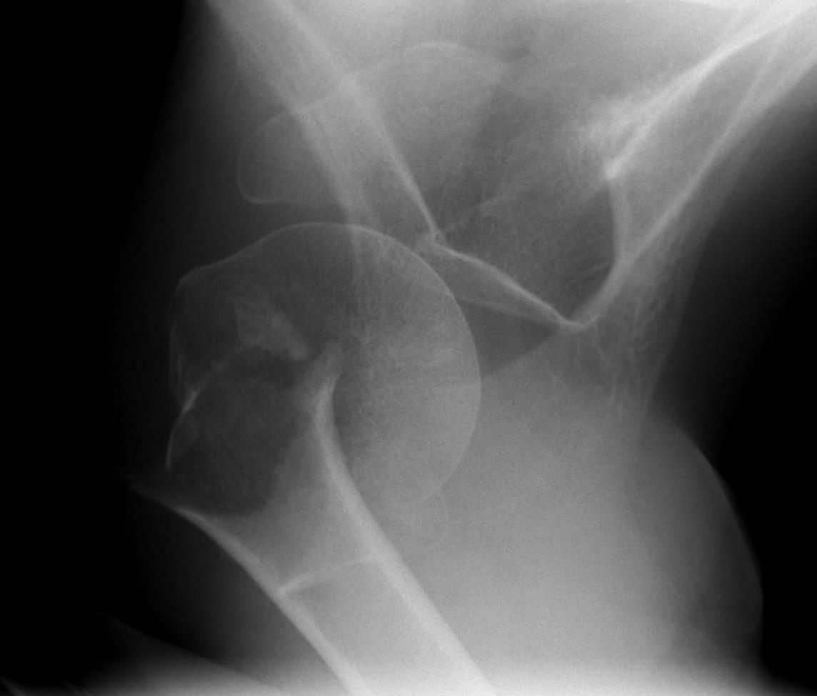 Shoulder Fracture Dislocation Anterior